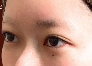 ギャラリークリニック銀座の二重の症例写真[ビフォー]