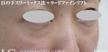 静岡美容外科橋本クリニックの目元・クマ・眉下・涙袋整形の症例写真[ビフォー]