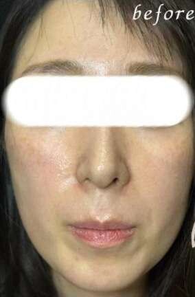 ゴルゴラインヒアルロン酸の症例写真[ビフォー]