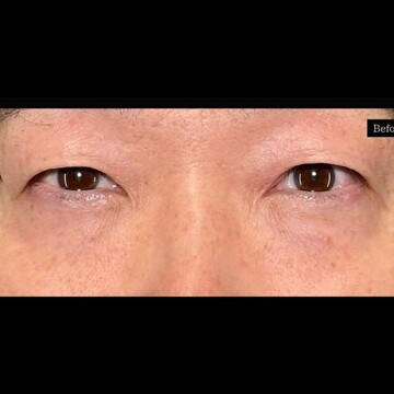 PRISM Beauty Clinicの目元の症例写真[ビフォー]