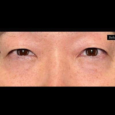クマ取り×ヒアルで膨らみを改善👏🏻の症例写真[ビフォー]