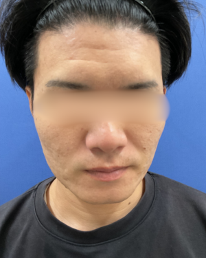 フェミークリニックの症例写真[アフター]