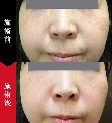 椿クリニックのシミ取り・肝斑・毛穴治療の症例写真