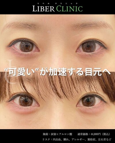 涙袋ヒアルロン注射の症例写真
