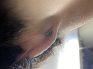 耳の後ろのしこり みずぶくれ ピアス穴あけ 耳のピアス の治療への不安 痛み 失敗 副作用