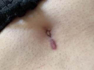 へそピアスの排除痕です きれいに治りますか ピアス穴あけ ボディピアス の治療への不安 痛み 失敗 副作用