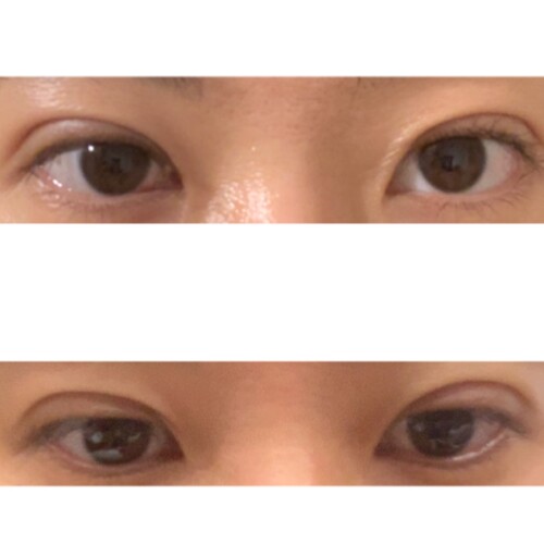 二重埋没後 右目 写真向かって左 がつり上がります 目 二重整形 二重埋没法 の治療への不安 痛み 失敗 副作用