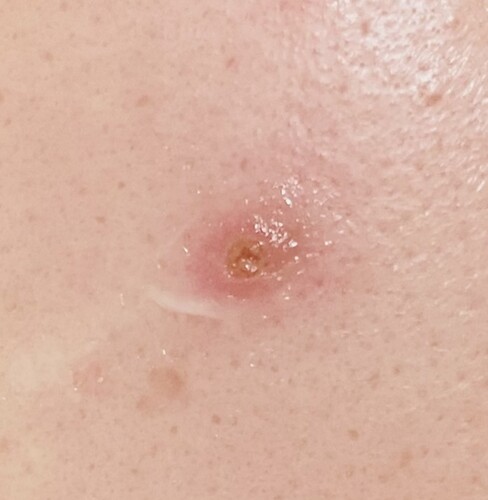 ニキビの赤みとかさぶた ニキビ ニキビ跡の治療 その他 ニキビ治療 の治療への不安 痛み 失敗 副作用