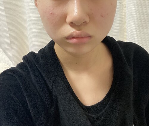 顔周りの肉と輪郭について 輪郭 顎の整形の治療方法 適応