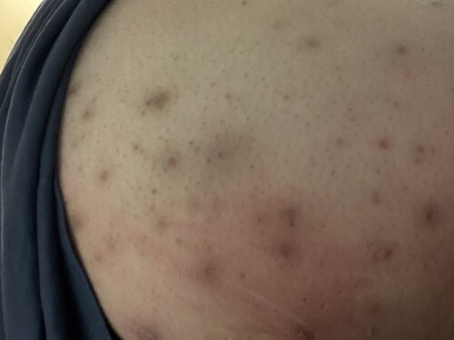 臀部 胸の下のにきび ニキビ ニキビ跡の治療の治療方法 適応