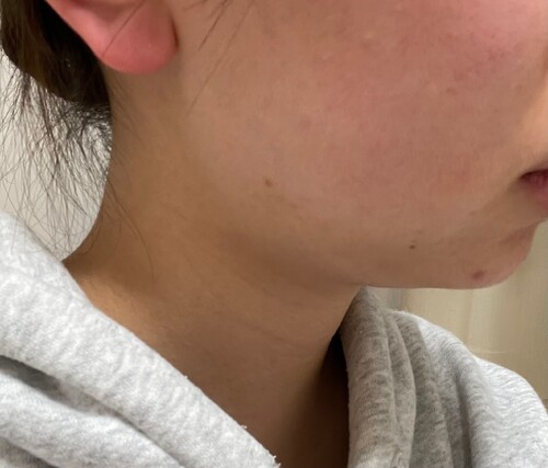 顎下腺にボトックスをうちたい 輪郭 顎 エラ 額 小顔整形 エラ 小顔ボトックス の治療方法 適応