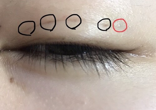 埋没三点留め後の白いポツは放っておけば消える 目 二重整形 二重埋没法 の治療への不安 痛み 失敗 副作用