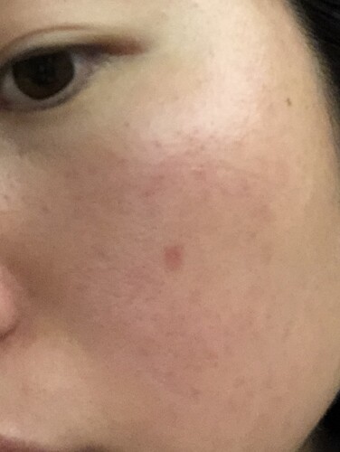 8ヶ月以上前のホクロ除去跡 ほくろ除去 あざ治療 イボ治療の治療方法 適応