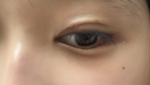 埋没後のものもらい 痛みがある場合は抜糸するべき 目 二重整形 二重埋没法 の治療への不安 痛み 失敗 副作用