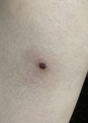 ホクロ除去後の色 ほくろ除去 あざ治療 イボ治療 ほくろのレーザー治療 の治療への不安 痛み 失敗 副作用