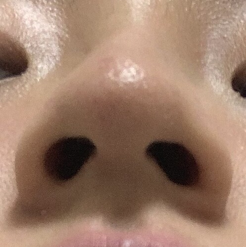 歯列矯正中の鼻整形について 鼻の整形の治療方法 適応