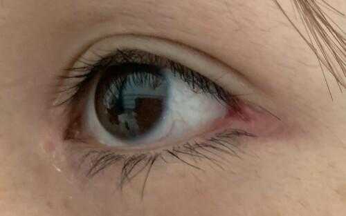 目尻切開後の傷口 目 二重整形 目頭切開 目尻切開 の治療方法 適応