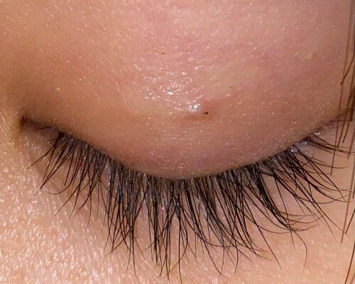 埋没 糸が見えている 目 二重整形 二重埋没法 の治療への不安 痛み 失敗 副作用