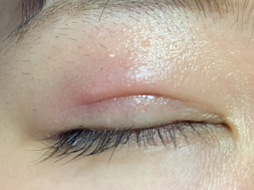 埋没法後のボコッとした物は化膿 治す方法は抜糸しかない 目 二重整形 二重埋没法 の治療への不安 痛み 失敗 副作用