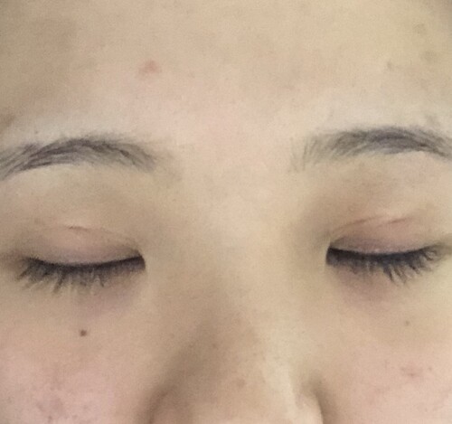 埋没後の左右非対称 目 二重整形 二重埋没法 の治療への不安 痛み 失敗 副作用