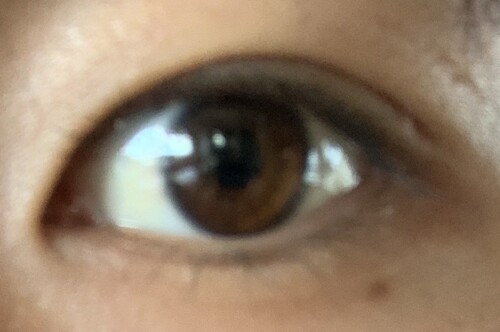 二重瞼 瞼が伸びていますか 目 二重整形の治療方法 適応