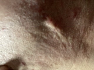 ニキビ跡による肌のデコボコ ケロイドへの治療 ニキビ ニキビ跡の治療の治療方法 適応