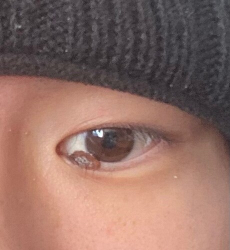 右目の内瞼に大きいホクロがあり除去したいです ほくろ除去 あざ治療 イボ治療 その他 ほくろ除去 の治療方法 適応