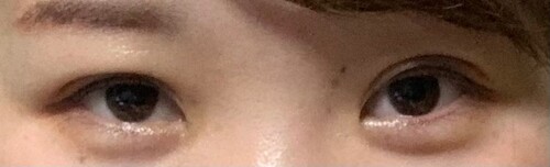 二重埋没の左右差がとにかく酷いです 目 二重整形 二重埋没法 の治療への不安 痛み 失敗 副作用