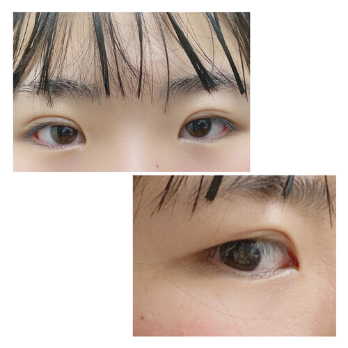 埋没の左右差とくい込みの浅さ 目 二重整形 二重埋没法 の治療への不安 痛み 失敗 副作用