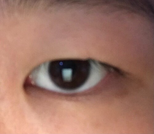 目をスッキリとした印象にしたい 目 二重整形の治療方法 適応