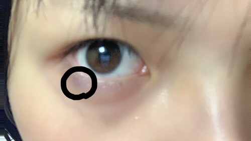 涙袋形成 内出血 らしきものができたが大丈夫か 目元 クマ 眉下 涙袋整形 涙袋形成 の治療への不安 痛み 失敗 副作用