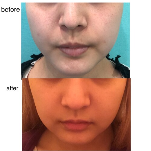 脂肪吸引失敗 輪郭 顎 エラ 額 小顔整形の治療への不安 痛み 失敗 副作用