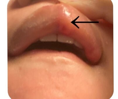 唇ヒアルロン酸のしこり 腫れ 口元 唇の整形 人中短縮 ヒアルロン酸注入 口元 唇 の治療への不安 痛み 失敗 副作用