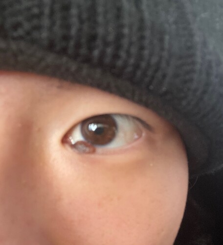 右目の内瞼に大きいホクロがあり除去したいです ほくろ除去 あざ治療 イボ治療 その他 ほくろ除去 の治療方法 適応