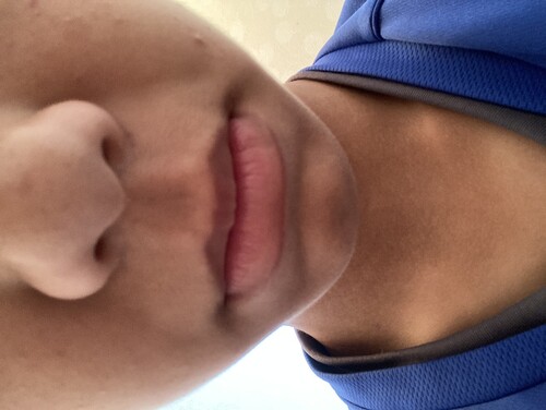 ほうれい線の治療方法は しわ たるみ整形 注入 糸 フェイスリフト ほうれい線の整形 の治療方法 適応