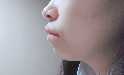 上顎前突の矯正方法 輪郭 顎 エラ 額 小顔整形の治療方法 適応