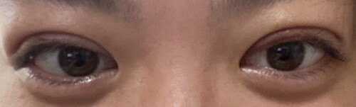 埋没法 腫れ 食い込みがきつい 目 二重整形の治療への不安 痛み 失敗 副作用