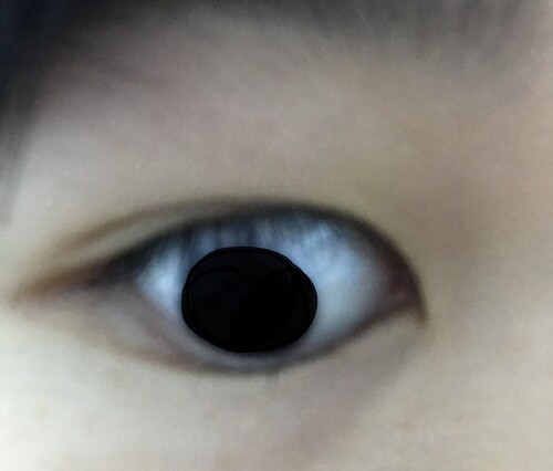 瞼が伸びた気がします 目 二重整形のその他