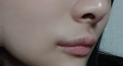 笑っても歯が見えない 口元 唇の整形 人中短縮の治療方法 適応