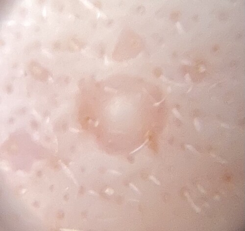 ニキビ跡 改善する治療 ニキビ ニキビ跡の治療の治療方法 適応