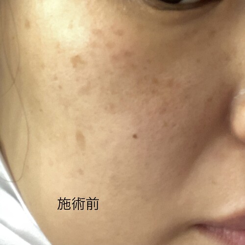 ピコレーザー施術後の色素沈着 シミ取り 肝斑 毛穴治療の治療への不安 痛み 失敗 副作用