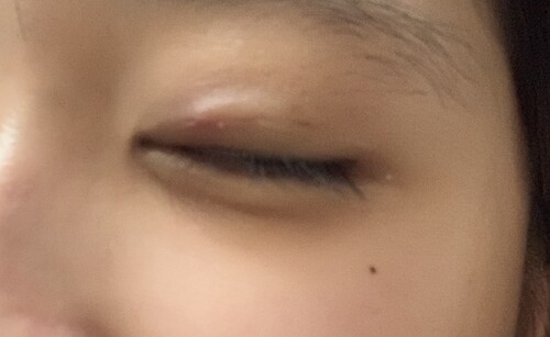 埋没後のものもらい 痛みがある場合は抜糸するべき 目 二重整形 二重埋没法 の治療への不安 痛み 失敗 副作用