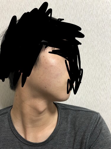 ニキビ ニキビ跡 色素沈着 赤み ニキビ ニキビ跡の治療の治療方法 適応