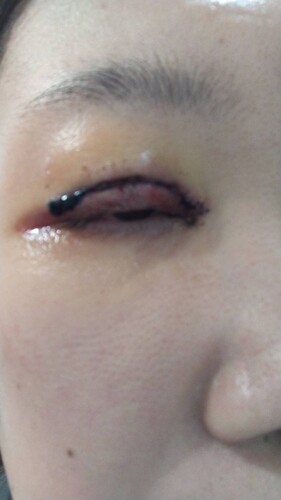 眼瞼下垂術後と目頭の白いぷよぷよ 目 二重整形 眼瞼下垂 の治療への不安 痛み 失敗 副作用