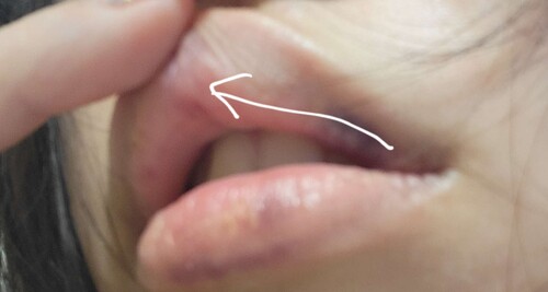 唇ヒアルロン酸注入後の白いデキモノ 口元 唇の整形 人中短縮 ヒアルロン酸注入 口元 唇 の治療への不安 痛み 失敗 副作用