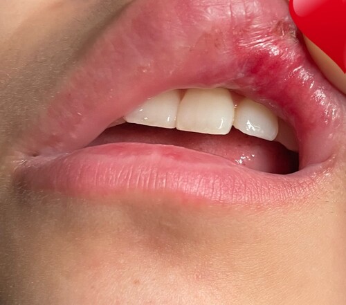 唇ヒアルロン酸周囲の腫れと内出血がひどい 口元 唇の整形 人中短縮 ヒアルロン酸注入 口元 唇 の治療への不安 痛み 失敗 副作用