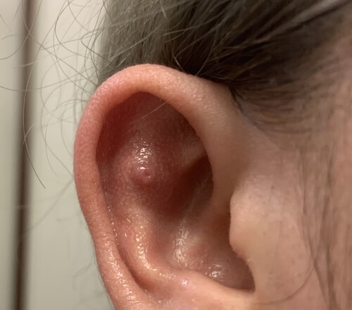 軟骨にできた肉芽について ピアス穴あけ 耳のピアス の治療への不安 痛み 失敗 副作用