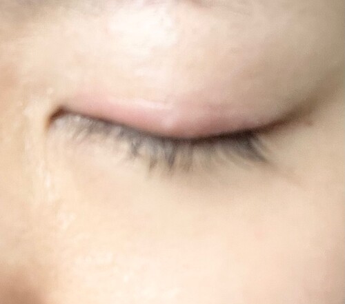 二重ラインの下に白い出来物ができました 目 二重整形 二重埋没法 の治療への不安 痛み 失敗 副作用