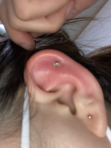 軟骨ピアスの腫れ ピアス穴あけ 耳のピアス の治療への不安 痛み 失敗 副作用