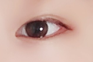 二重埋没が取れかけているため左右差が気になります 目 二重整形 二重埋没法 の治療方法 適応